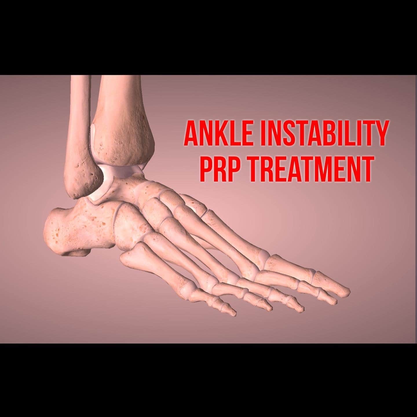 Treating ankle pain with PRP