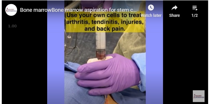 Bone marrow aspiration to prepare stem cell treatment