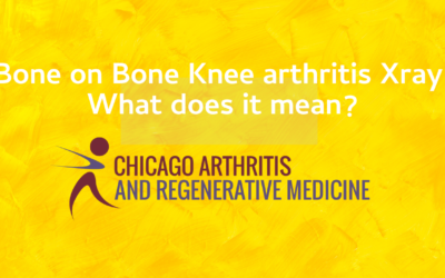 Bone on Bone Knee Arthritis on Xray- What does that mean?