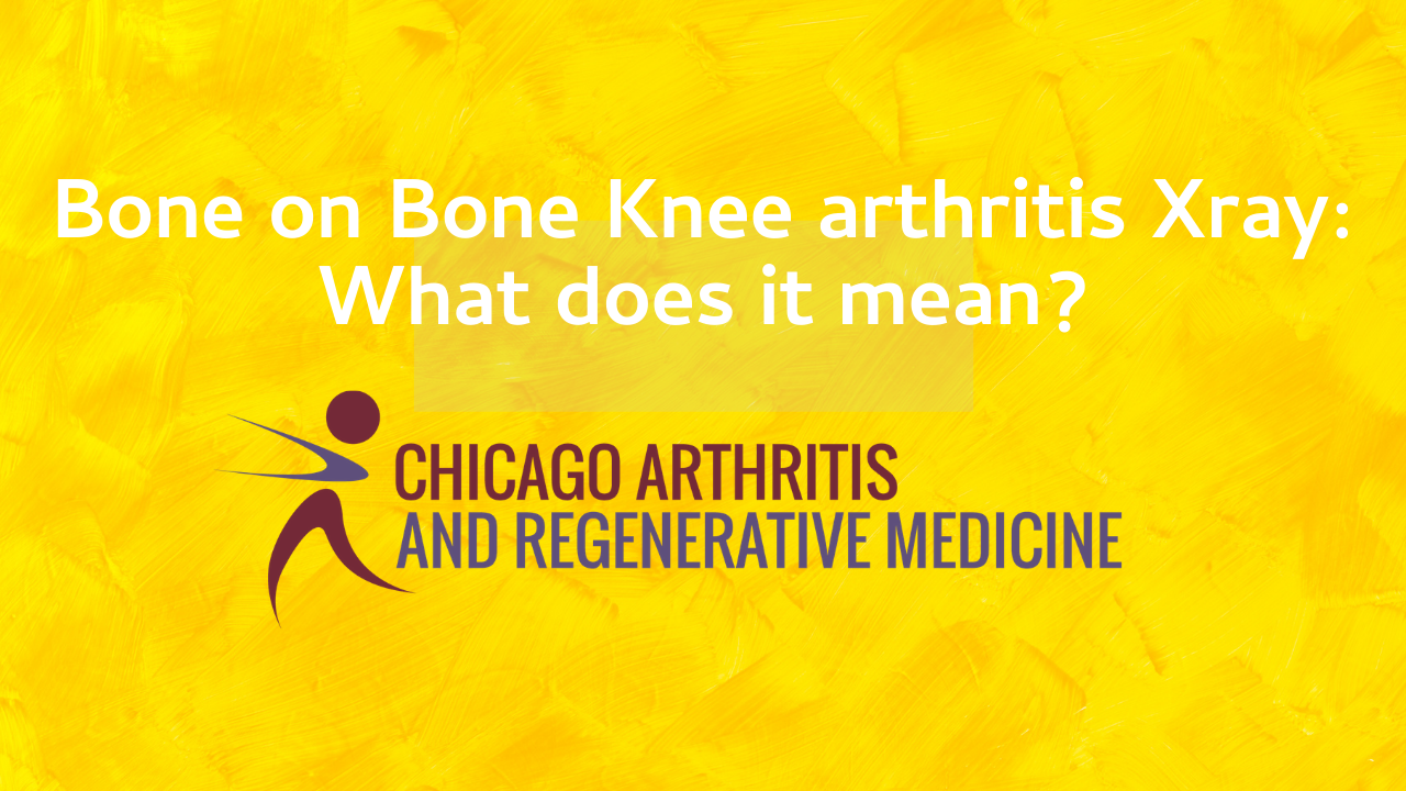 Bone on Bone Knee Arthritis on Xray- What does that mean?