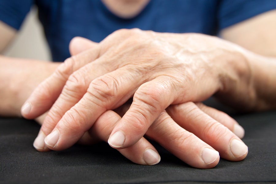 What are the signs of arthritis in the hands? - UChicago Medicine