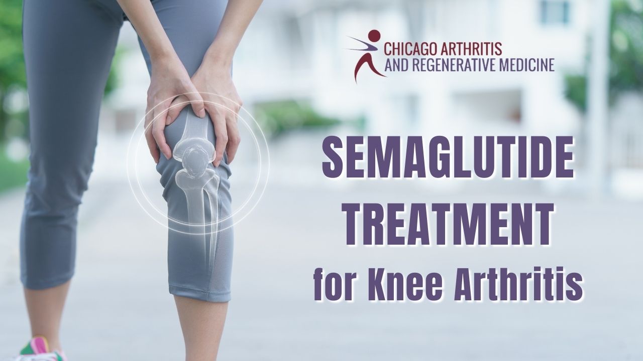 Semaglutide Treatment for Knee Arthritis
