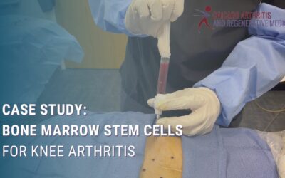 Case Study: Bone Marrow Stem Cells for Knee Arthritis | Chicago Arthritis