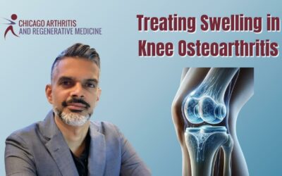 Treating Swelling in Knee Osteoarthritis