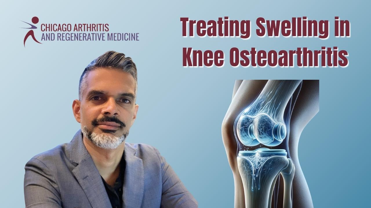 Treating Swelling in Knee Osteoarthritis