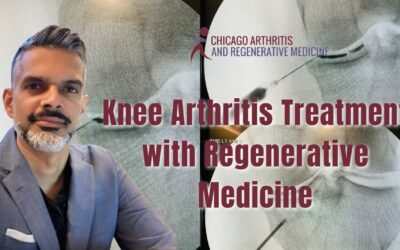 Treating Osteoarthritis and Knee Pain with Regenerative Medicine