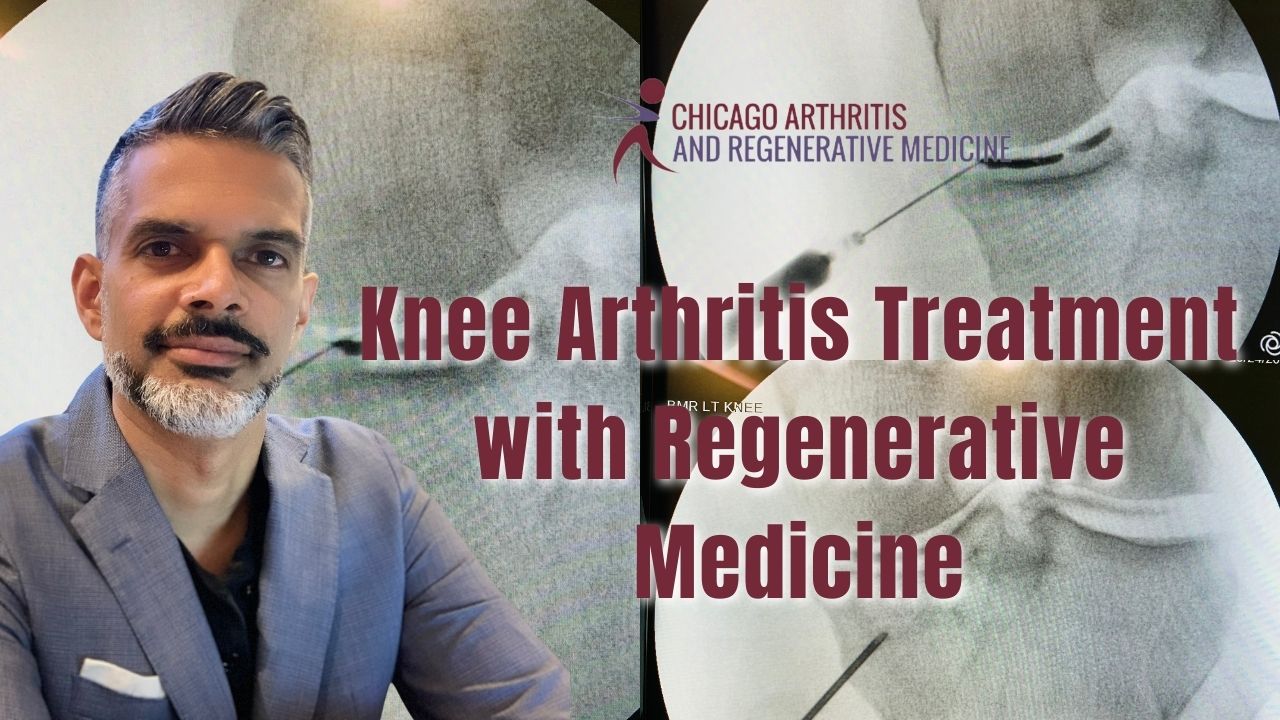 Treating Osteoarthritis and Knee Pain with Regenerative Medicine