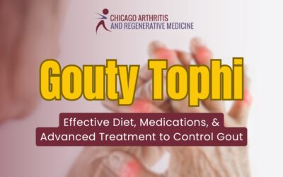 Gouty Tophi: Effective Diet, Medications, & Advanced Treatment to Control Gout