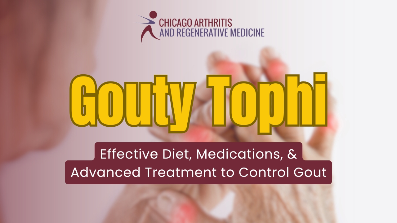 Gouty Tophi: Effective Diet, Medications, & Advanced Treatment to Control Gout