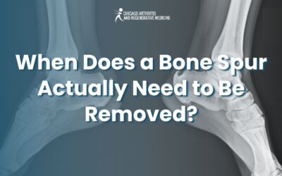 When Does a Bone Spur Actually Need to Be Removed?