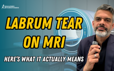 Labrum Tear on MRI: Here’s What It Actually Means
