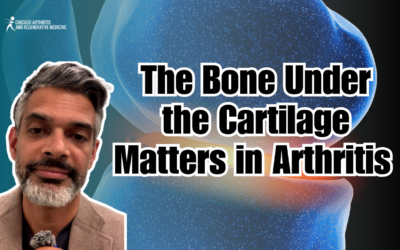 The Bone Under the Cartilage Matters in Arthritis