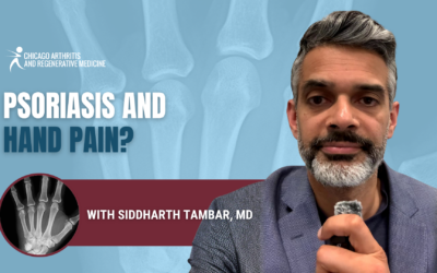 Psoriasis and Hand Pain: How to Know If It’s Psoriatic Arthritis