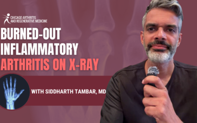 Burned-Out Arthritis: What It Means When Inflammation Fades but Joint Damage Remains